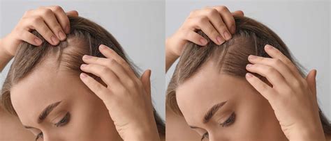 Hair Loss In Women Causes Treatment Prevention