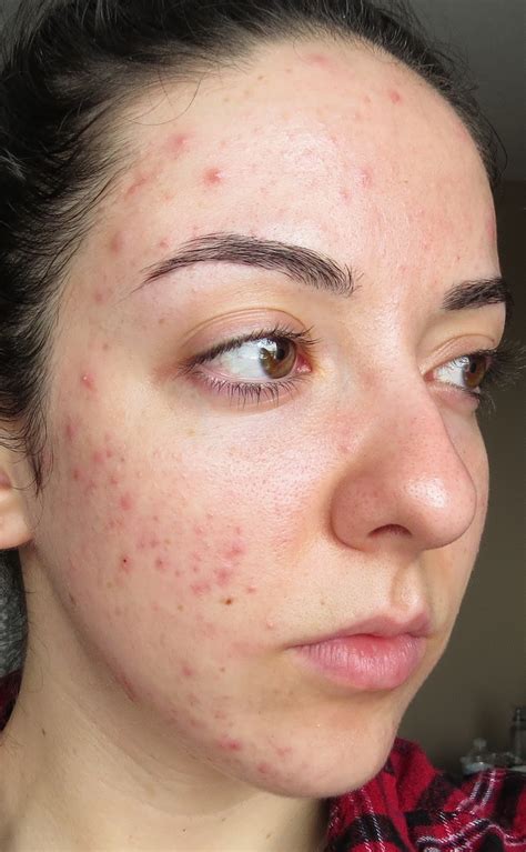 My Skins Journey Week 37 Banish Acne Scars