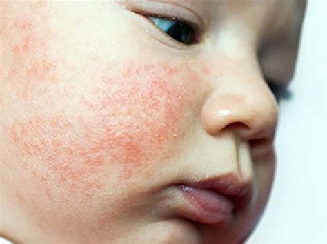 Dermatite Atopica Nel Neonato O Eczema Infantile Cause Sintomi E