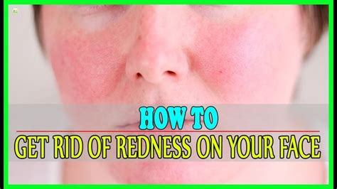 Whether Your Face Has A Tinge Of Redness All Over Or Even Worse
