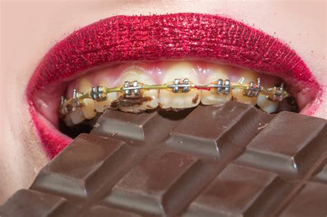 what are the things you can t eat with braces dental braces