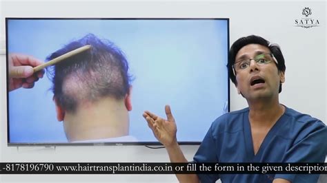 Best Hair Transplant Clinic Hair Transplant India Hair Transplant