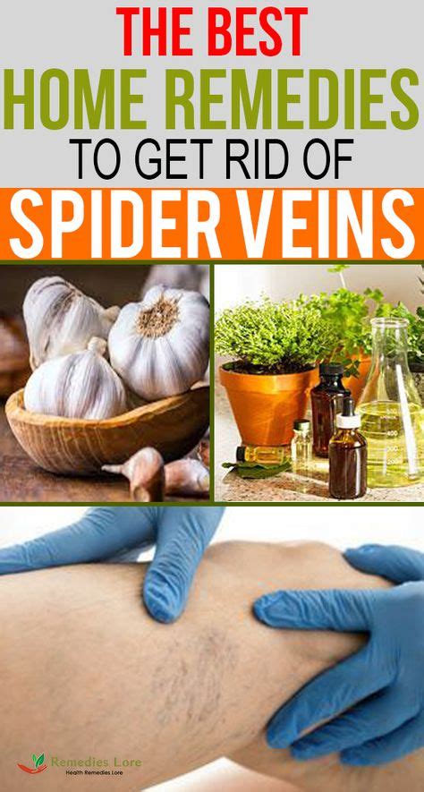 The Best Home Remedies To Get Rid Of Spider Veins Spider Vein Remedies Get Rid Of Spider