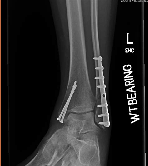 Broken Ankle Weeks 78 6 Weeks After Orif Surgery And 7 Weeks By