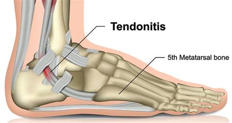 Peroneal Tendonitis Tendinopathy Symptoms Causes And Treatment