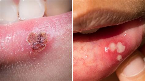Canker Sore Vs Cold Sore Whats The Difference