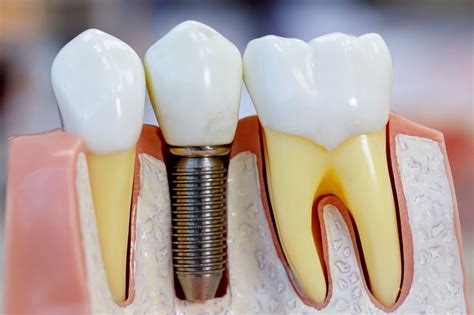 Dental Implant Procedure Steps Adam Fienman Dds West Bloomfield