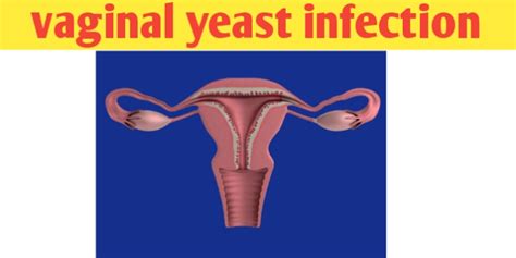 Vaginal Yeast Infection Causes Symptoms Discharge Biologysir