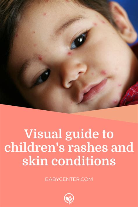 Baby Rash A Visual Guide To Skin Rashes In Babies And
