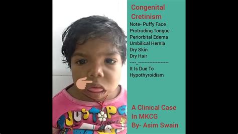 Congenital Cretinism A Clinical Case In Mkcg By Asim Swain Youtube