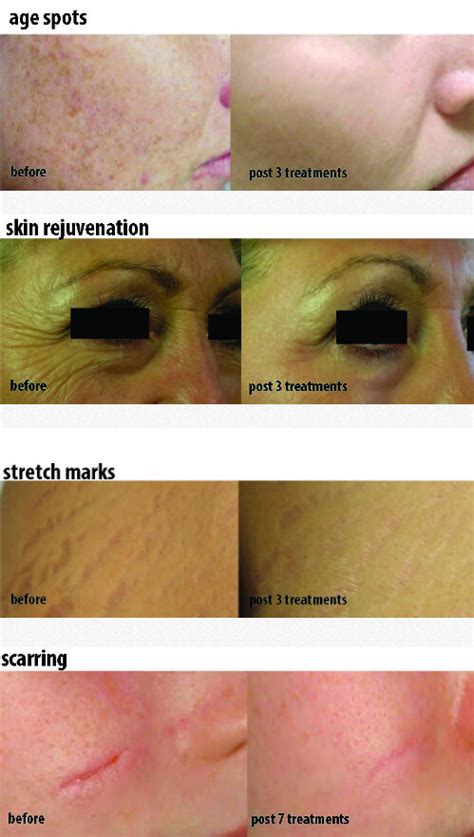 Ipl Skin Treatment Before And After Your Magazine Lite