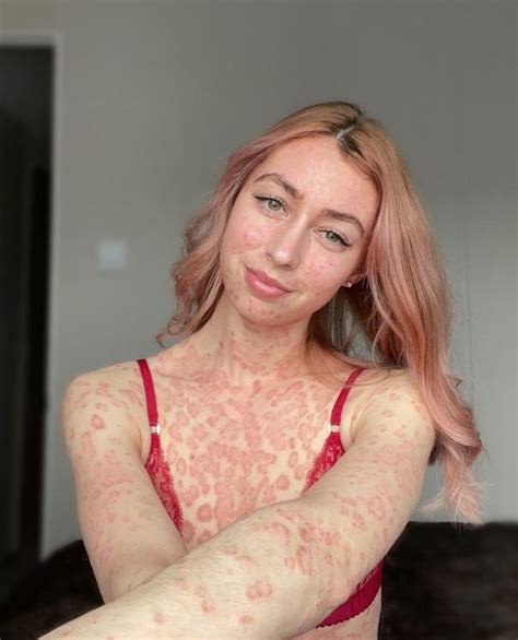 Woman With Psoriasis Hated Looking In Mirror But Now Bares Skin In Lingerie I Know All News