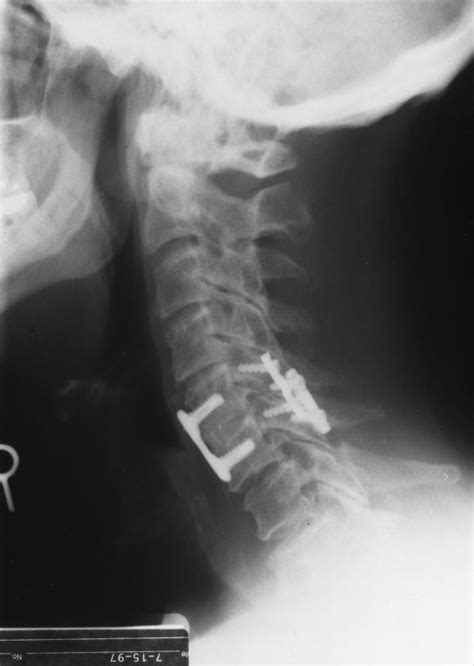 Missed Cervical Spine Fracture Dislocations The Importance Of Clinical