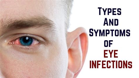 Types And Symptoms Of Eye Infection