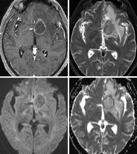 Primary Central Nervous System Lymphoma The Neurosurgical Atlas