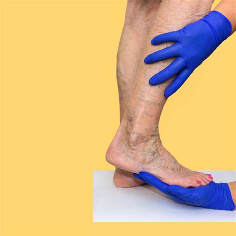 Bulging Vein Treatments And Causes The Vein Center Of Maryland