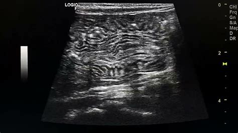 Transient Ileoileal Non Obstructing Intussusception Ultrasound Video