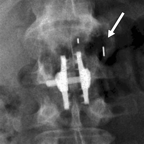 Imaging Of Current Spinal Hardware Lumbar Spine Ajr