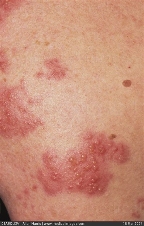 Stock Image Close Up Of Shingles Herpes Zoster Showing Small