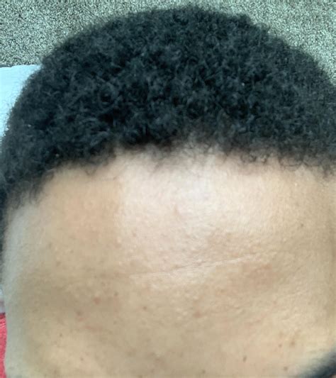 Need Advice On Getting Rid Of These Small Bumps On My Forehead What
