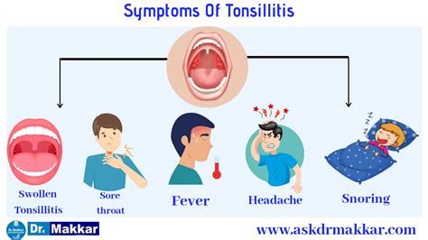 Tonsilstonsillitis Online Homeopathic Treatment India Symptoms