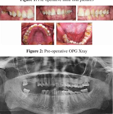 Figure 2 From A Permanent Solution To Restore Occlusal Vertical