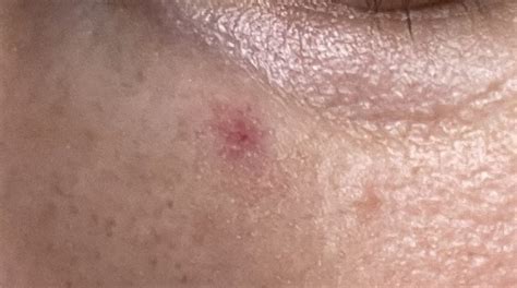 Skin Concerns I Have A Derm Appt Coming Up On 523 Does Anyone Know
