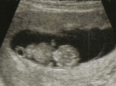 During week 15, your baby is looking more like a baby. Ultrasound at 8 Weeks: What to Expect - New Kids Center
