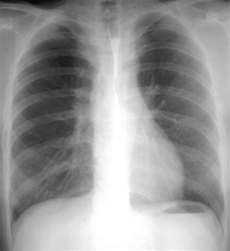 Figure 0311911 Chest Radiography Of A Patient With Coarctation Of The