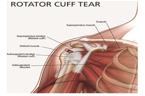 Impingement Syndrome And Rotator Cuff Tear