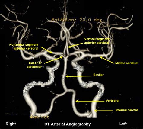 Image Result For Labeling Angiogram Circle Of Willis Circle Of Willis