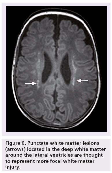 Radiological Assessment Of White Matter Injury In Very Preterm Infants