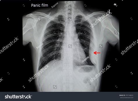 Chest Xray Film Patient Loculated Pleural Stock Photo 797148022