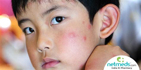 Mosquito Bite Allergies The Causes Symptoms And Treatment Of Skeeter