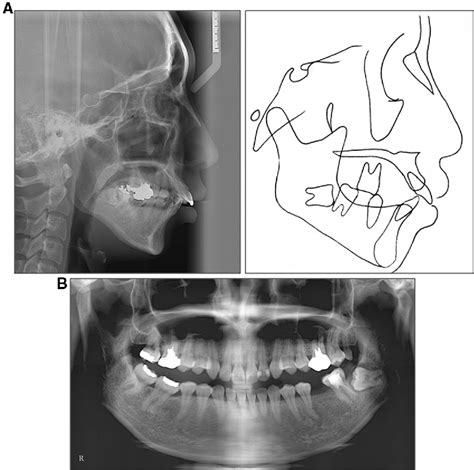 Figure 3 From Orthodontic Uprighting Of A Horizontally Impacted Third