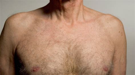 Male Breast Cancer How To Spot The Symptoms Plus What Happens After