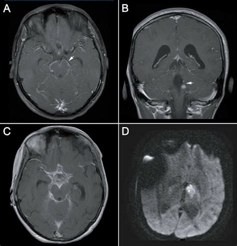 Brain Magnetic Resonance Imaging A Axial T1 Sequence With Gadolinium