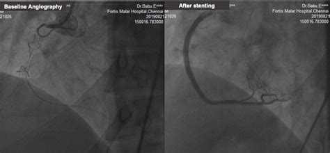 Coronary Angiography Vs Angioplasty Stenting