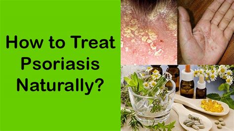 3 Home Remedies To Treat Psoriasis Naturally Best Herbal Health