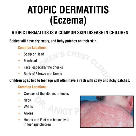 Atopic Dermatitis Eczema Dr Ankit Parakh
