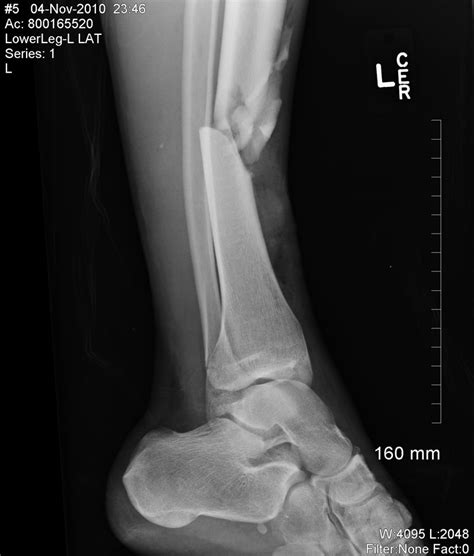 Leg Fracture Image Images FRACTURE