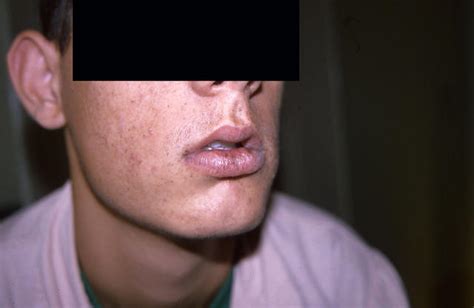 Pigmentation Disorders Peutz Jeghers Syndrome Picture Hellenic