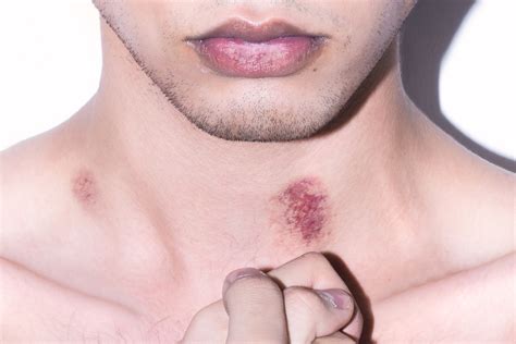 how to get rid of hickeys secret methods holistic meaning