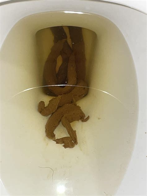 Colon Cancer Poop Look Like
