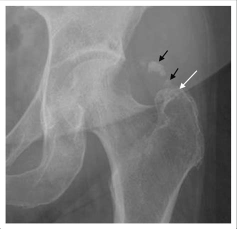 Anteroposterior Radiograph Of The Left Hip Globular Poorly Defined