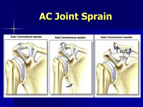 How To For A Level 1 Ac Joint Sprain Rehab