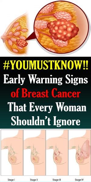 Early Warning Signs Of Breast Cancer That Every Woman Shouldn’t Ignore