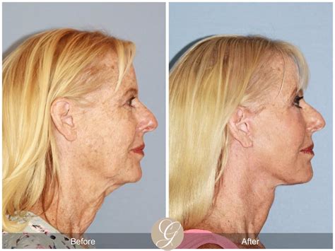 Neck Lift 412 Before After Photos Orange County