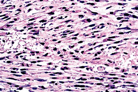 Pathology Outlines Anaplastic Carcinoma