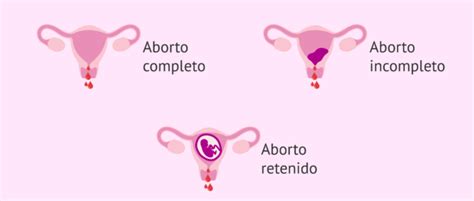 Tipos De Abortos Espontáneos Según La Variedad Clínica
